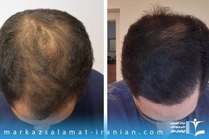 توصیه های بعد از کاشت مو