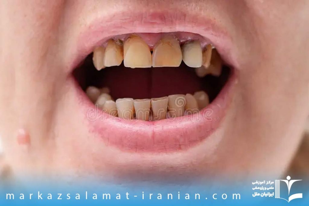 انواع بیماری های دندان