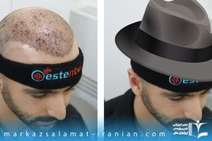 استفاده از کلاه بعد از کاشت مو