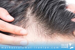 ریزش مو بعد کاشت