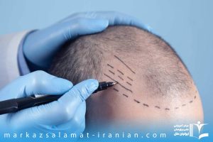 آشنایی با مهمترین مراقبت های بعد از کاشت مو