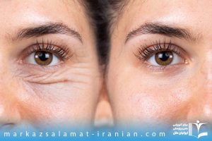 مزوژل و فیلر زیر چشم