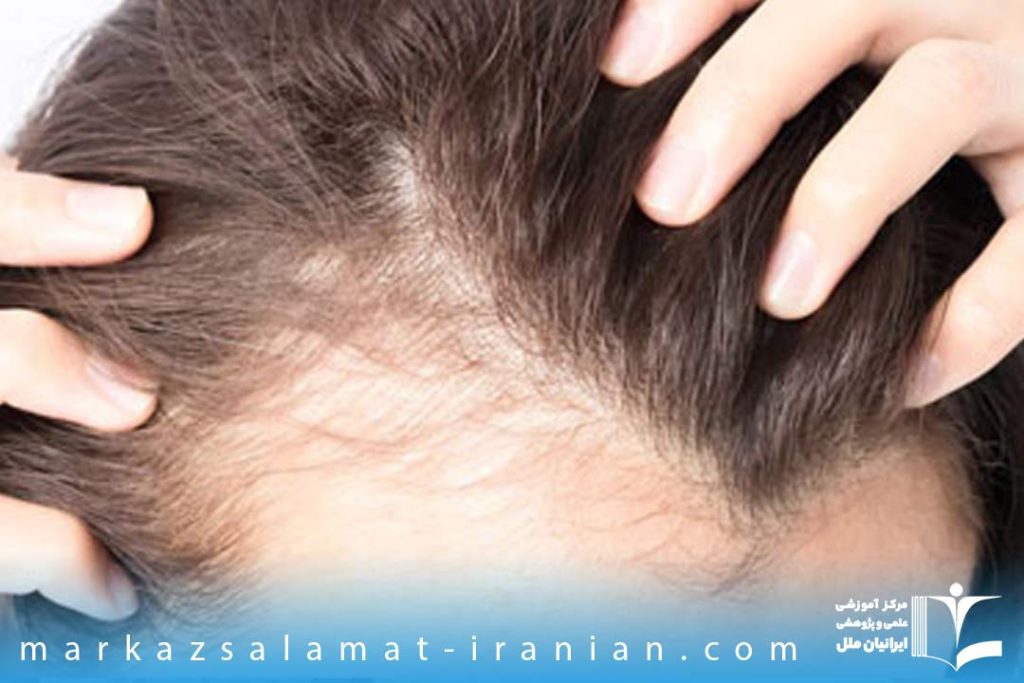 عامل اصلی ریزش مو