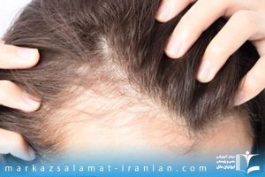 عامل اصلی ریزش مو