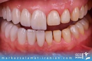 کامپوزیت ونیر