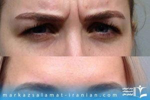 عوارض بوتاکس