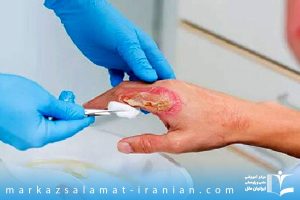 مراقبت های پرستار در سوختگی