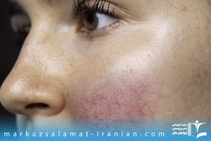 ژل و بوتاکس تقلبی