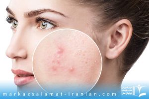 درمان جوش ها