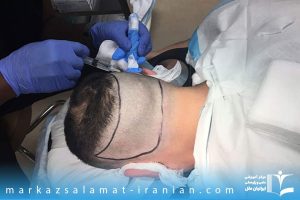 دوره آموزشی کاشت مو در کرمان با مدرک معتبر