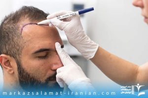 تکنسین کاشت مو در ارومیه