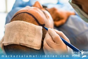 دوره آموزش کاشت مو در بوشهر