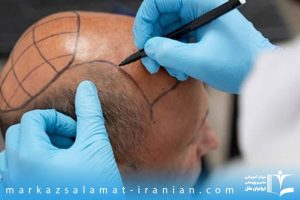 دوره آموزش کاشت مو در بندرعباس