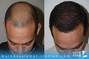 دوره آموزش کاشت مو در رشت با مدرک معتبر