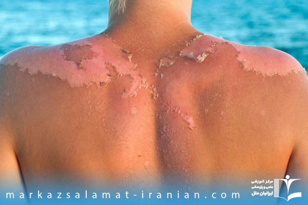 مسمومیت پوستی