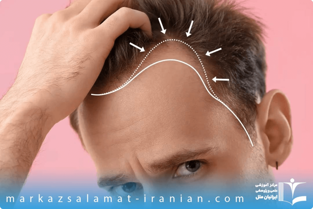 ابزارهای کاشت مو